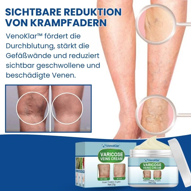 VenoKlar™ | Krampfadern- & Besenreiser-Creme