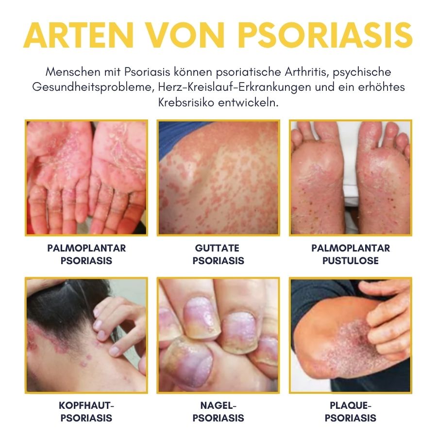 PsoriaFix™ | Bienenvenom Psoriasis Beruhigungsspray