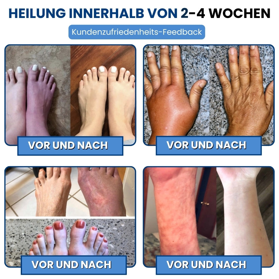 NeuroEase™ | Neuropathie Nerven Linderungscreme