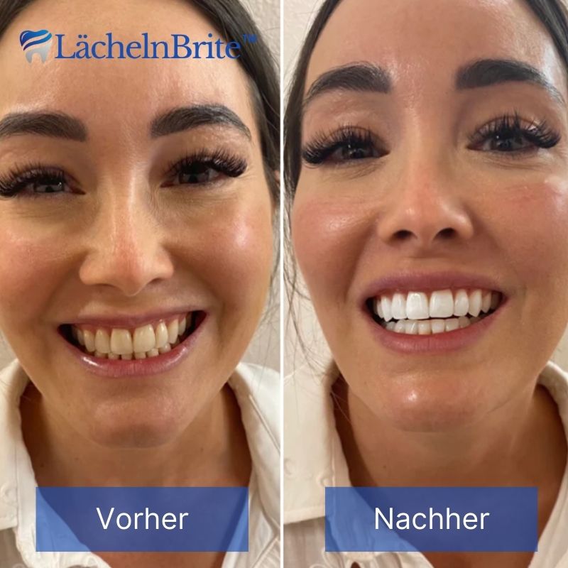 LächelnBrite™ | Nanoshine - Zahn Fleck Reiniger