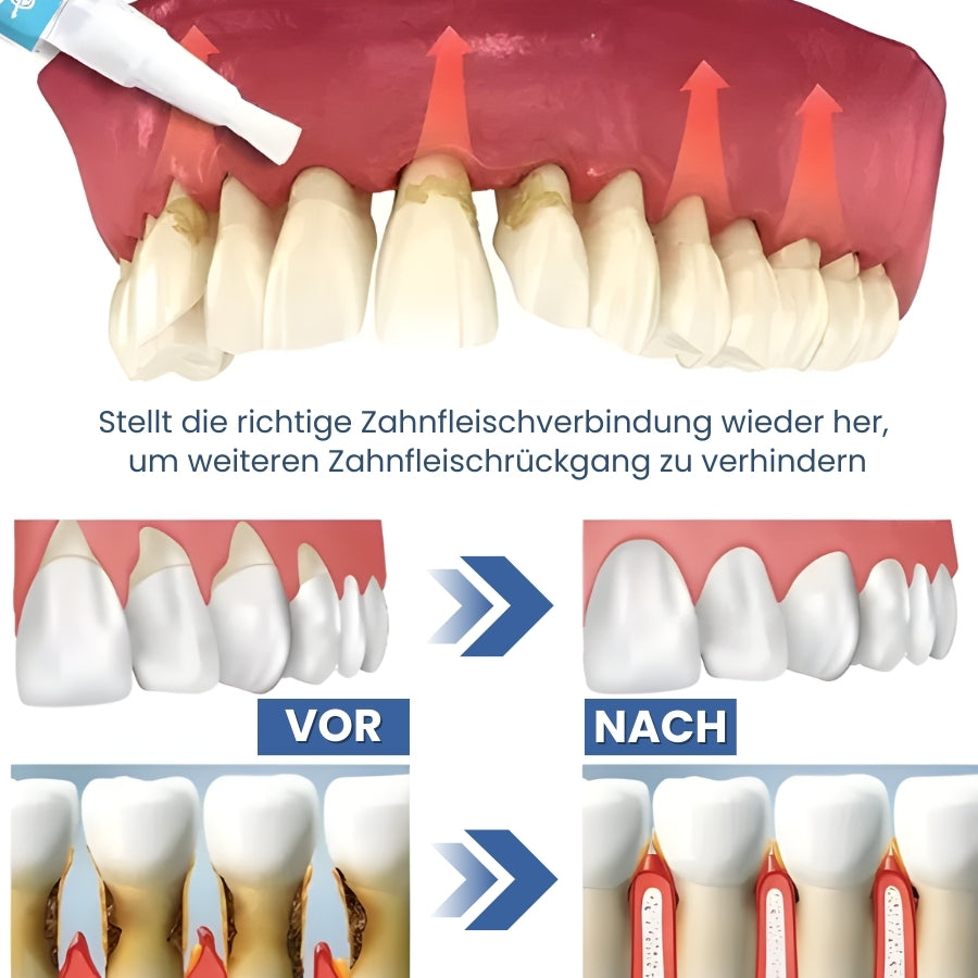 GumRevive™ | Zahnreparatur-Gel