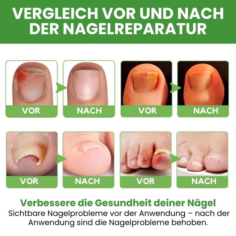NailPen™ | Reparaturstift gegen Nagelpilz & Entzündungen