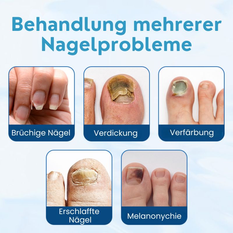 NagelHeil™ | Nagelpilz-Behandlungscreme