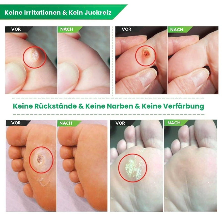 CalluFix™ | Aktives Hornhautentferner-Gel