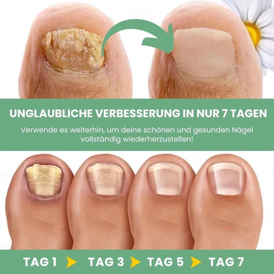 FungBoost™ | Nagelpilz-Behandlungsgel