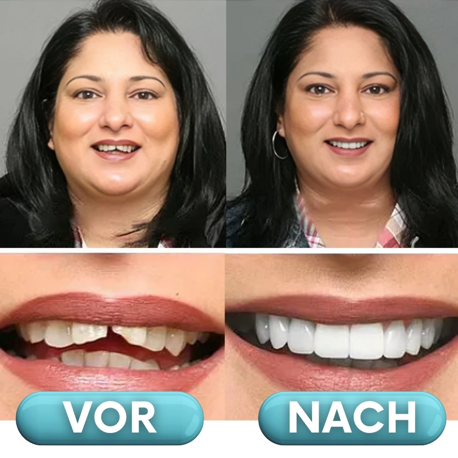 ProDenta™ | Anpassbare Aufsteckprothesen