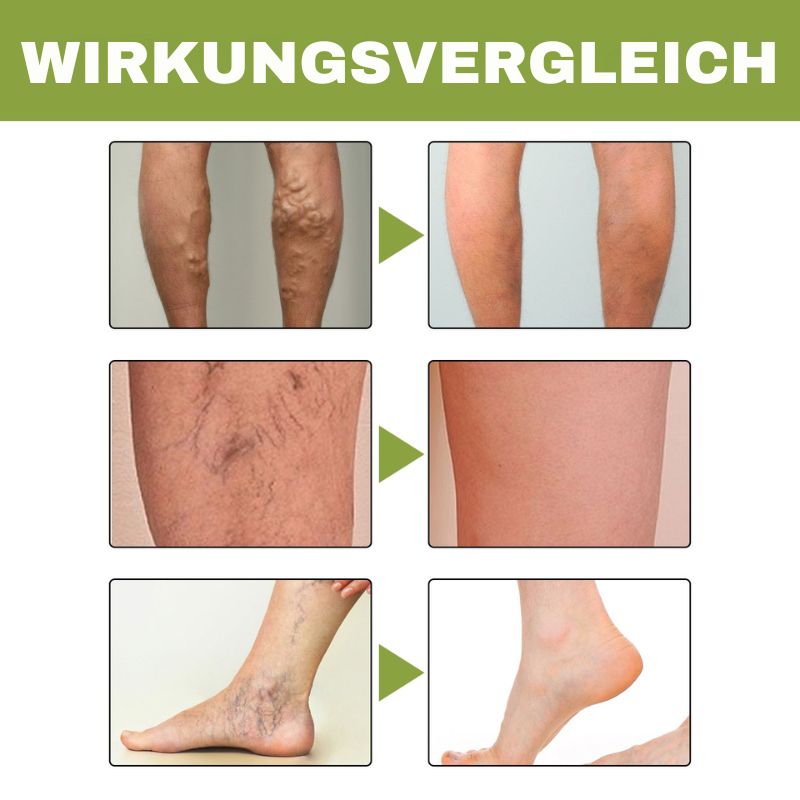 VeinCare™ | Krampfadern-Creme
