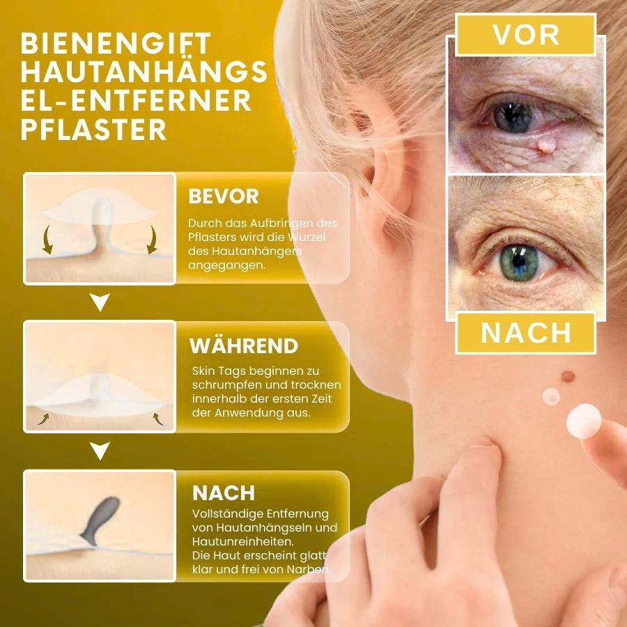 BeeKlar™ | Bienengift Hautanhängsel-Entferner Pflaster