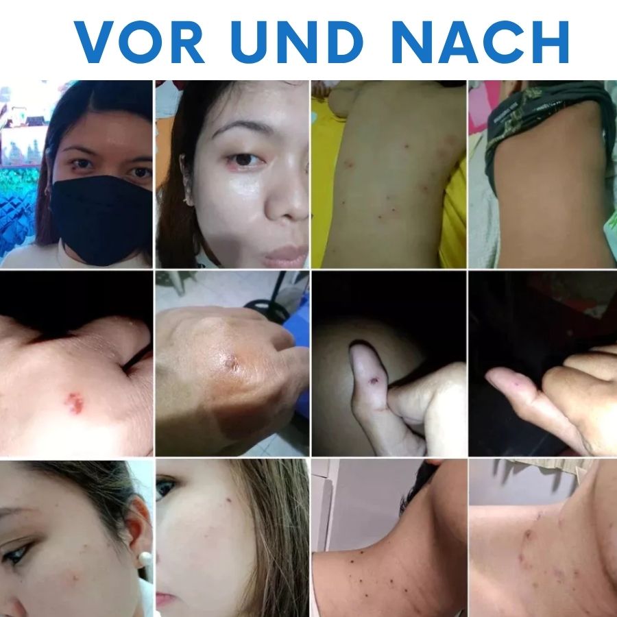 Tagiva™ | TagGone Warzenentfernungscreme