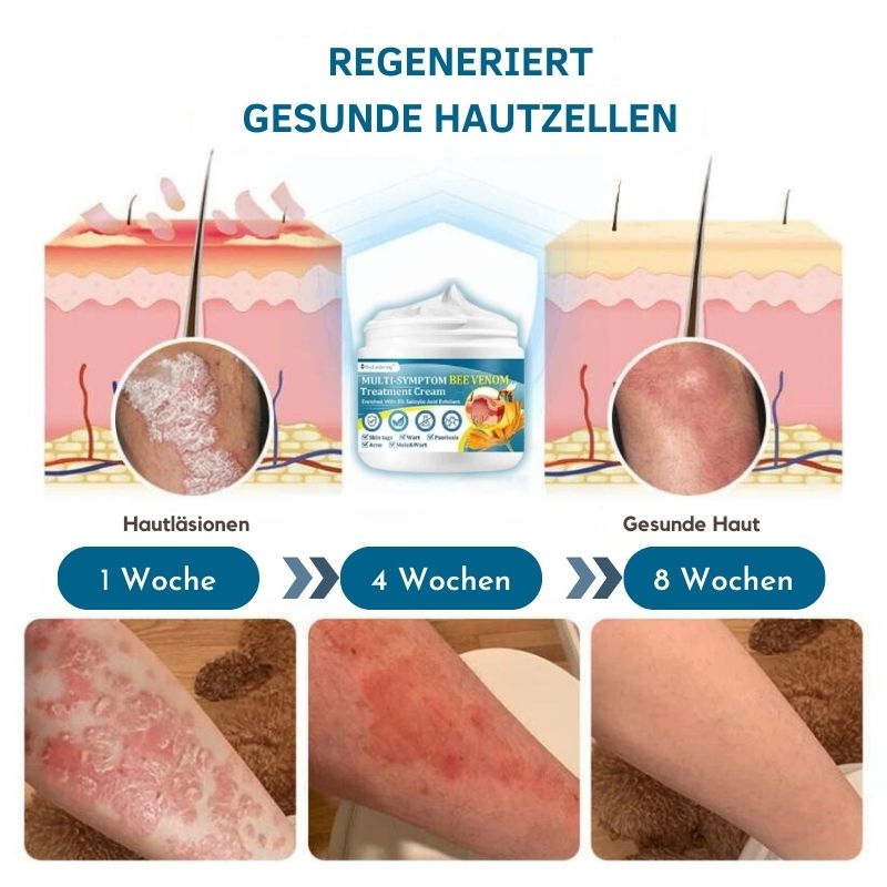 BeeLinderung™ |  Multi-Symptom-Bienengift-Behandlungscreme
