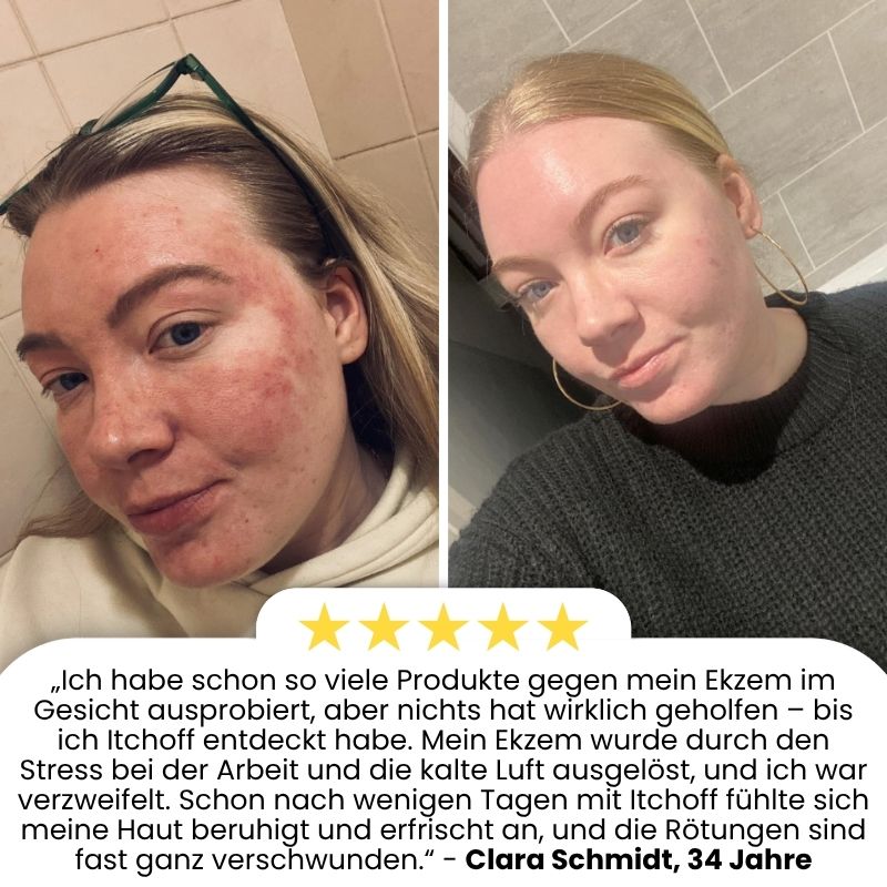 ItchOff™ | Antibakterielle Creme