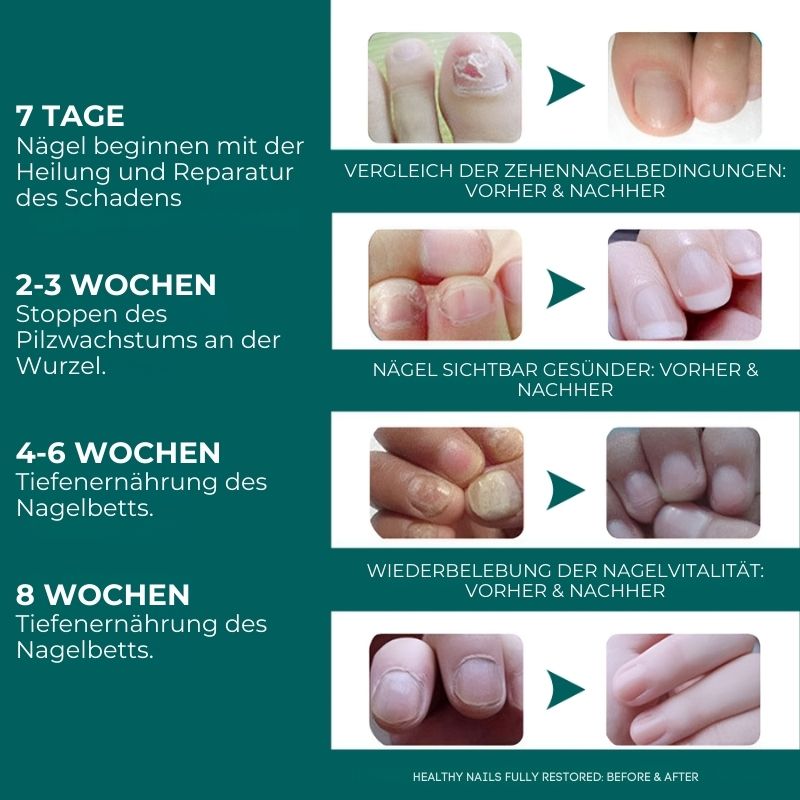 NagelPflege™ Stift | Nagelstift zur Bekämpfung von Nagelpilz