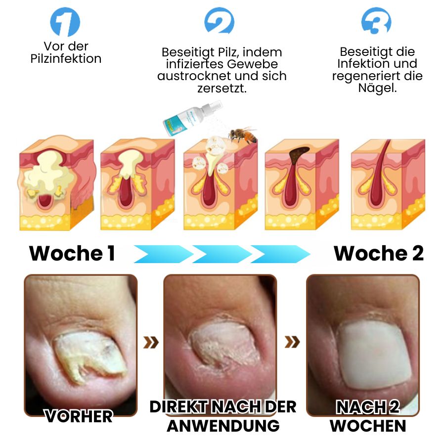 FungoHeal™ | Hochwertiges Antipilz-Spray