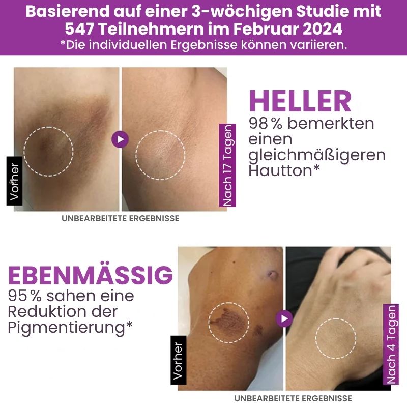 MelanoFix™ | Anti-Hyperpigmentierungsserum