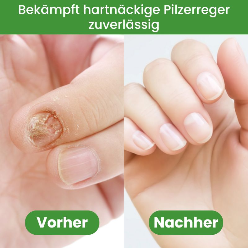 NailPen™ | Reparaturstift gegen Nagelpilz & Entzündungen