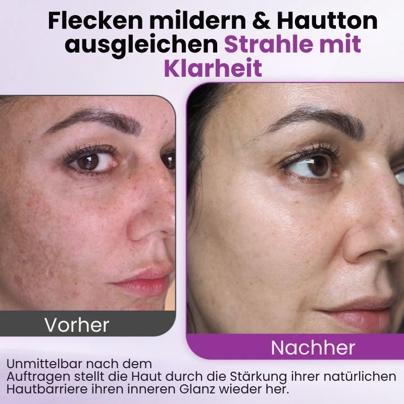MelanoFix™ | Anti-Hyperpigmentierungsserum