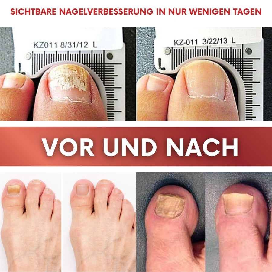 NailZen™ | Hagebuttenöl Nagelbehandlung