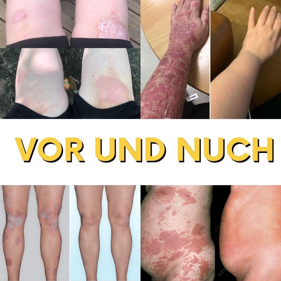 PsoriaFix™ | Bienenvenom Psoriasis Beruhigungsspray