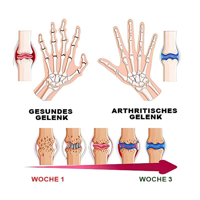 ArthroVeinSalbe™ | Creme zur Behandlung von Arthritis und Krampfadern