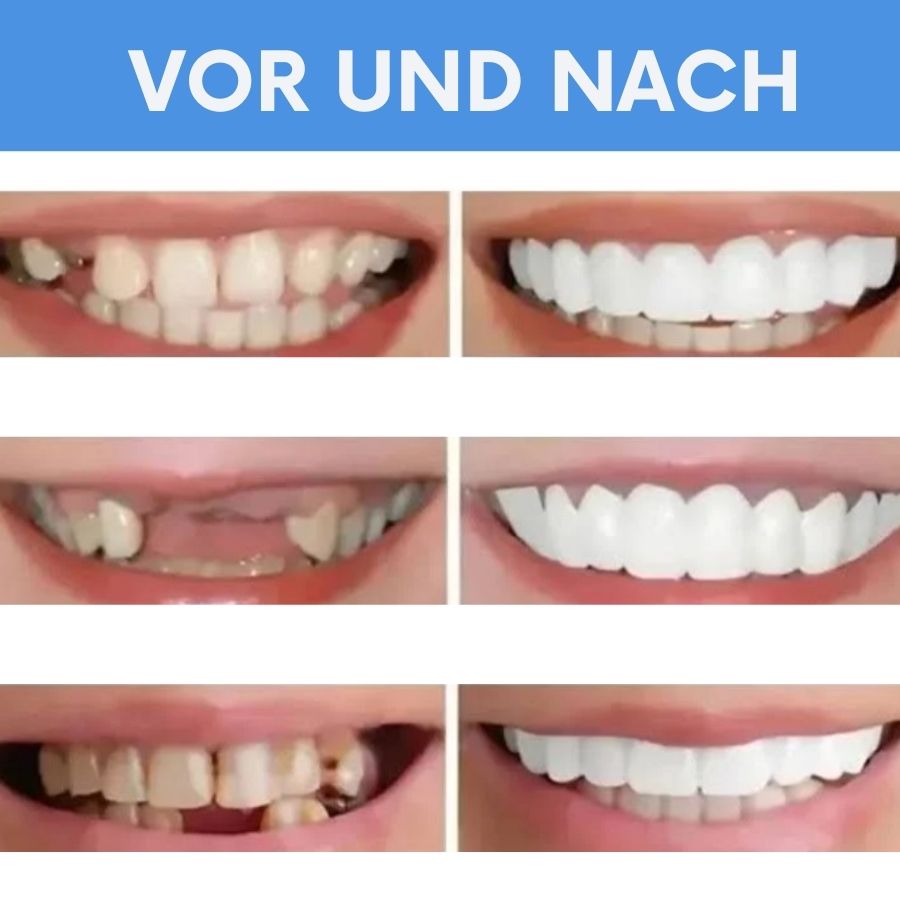 SmilePlus™ | Flex Zahnprothesen