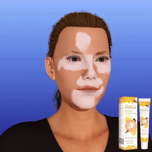 BienenKlar™ | Stellen Sie Hautverfärbungen in nur 7 Tagen wieder her!