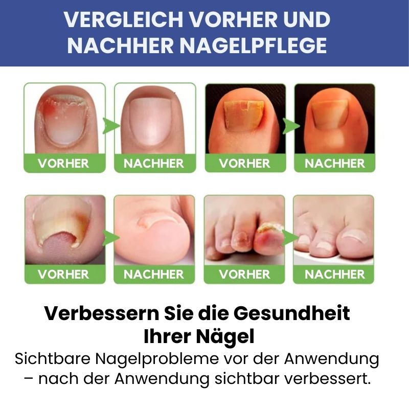 NagelFixer™ | Nagelpflege Roll-on