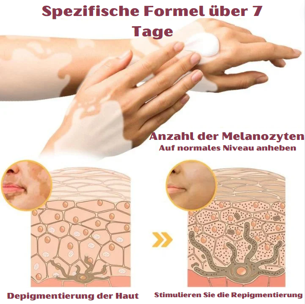 BienenKlar™ | Stellen Sie Hautverfärbungen in nur 7 Tagen wieder her!