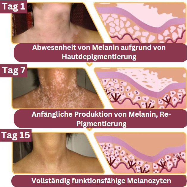 BienenKlar™ | Stellen Sie Hautverfärbungen in nur 7 Tagen wieder her!