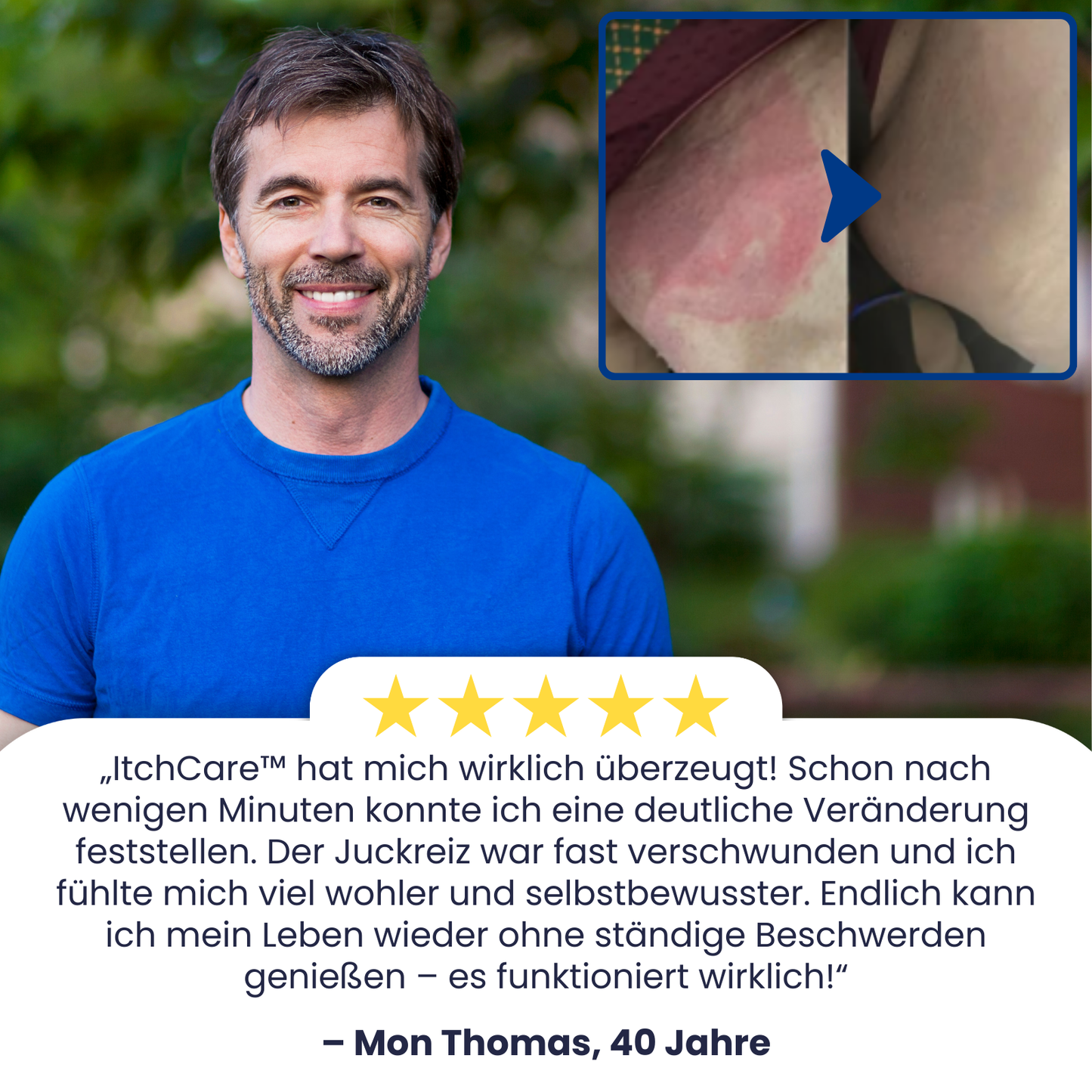 ItchCare™ | 95 % Sofortige Linderung!