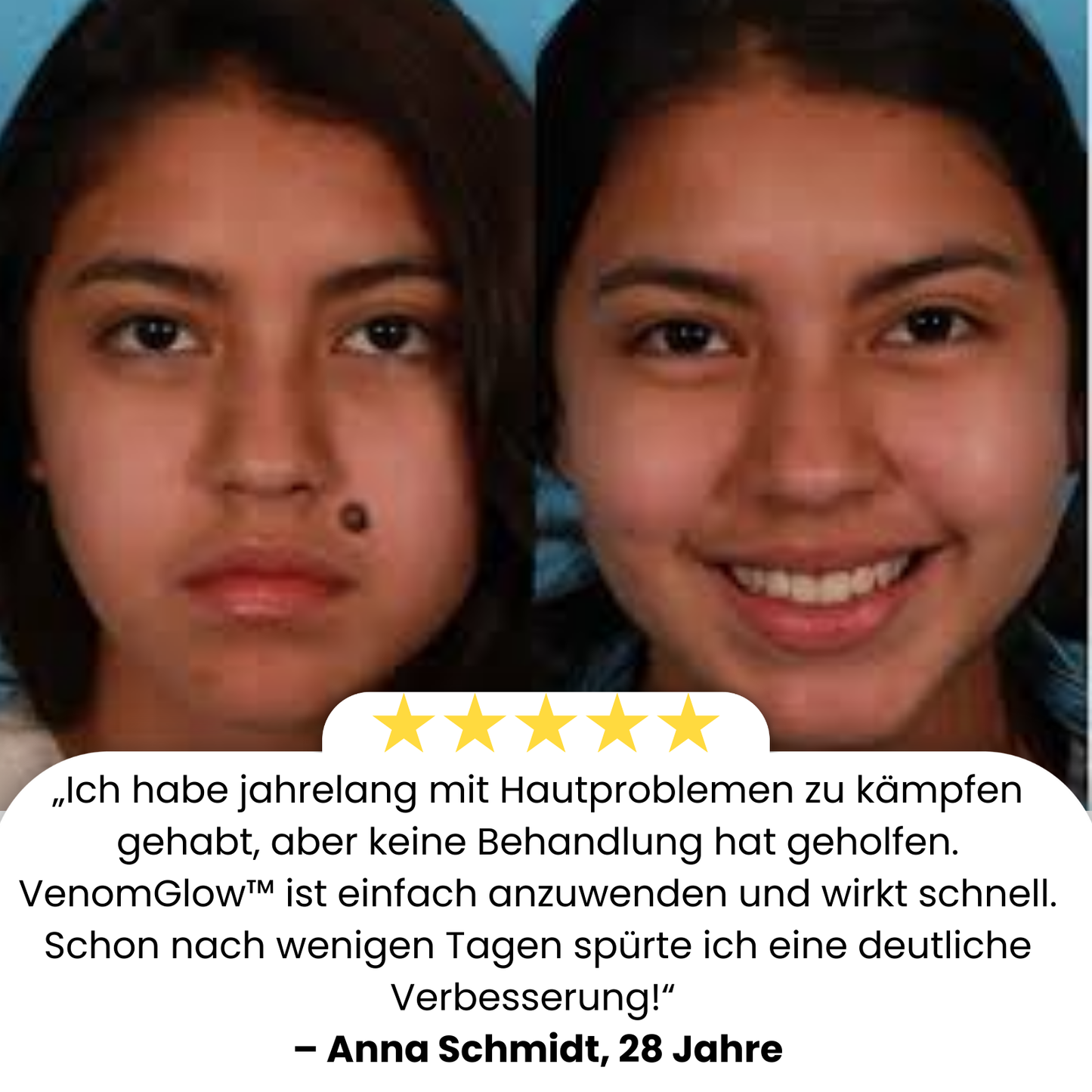 VenomGlow™ | Weg mit Muttermalen, Warzen & Ekzemen in 1 Woche!