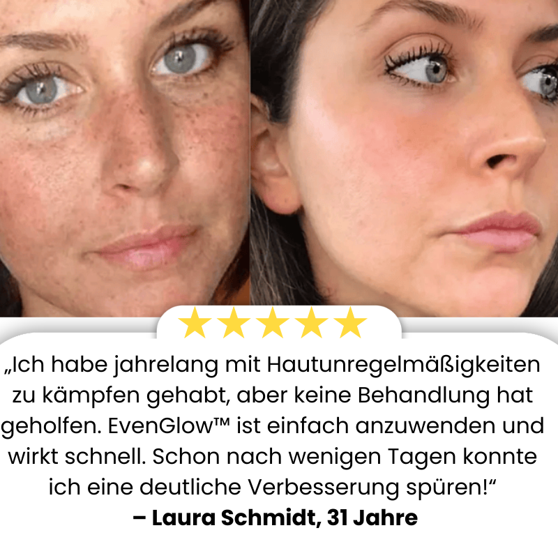EvenGlow™ Serum | Bleicht 92 % der dunklen Flecken!