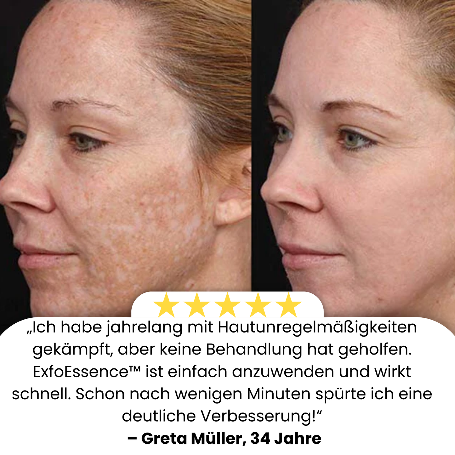 ExfoEssence™ | Erlebe frische, 95% glatte Haut sofort!
