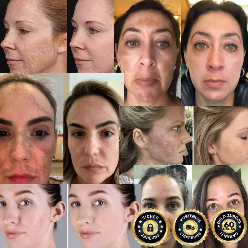 EvenGlow™ Serum | Bleicht 92 % der dunklen Flecken!