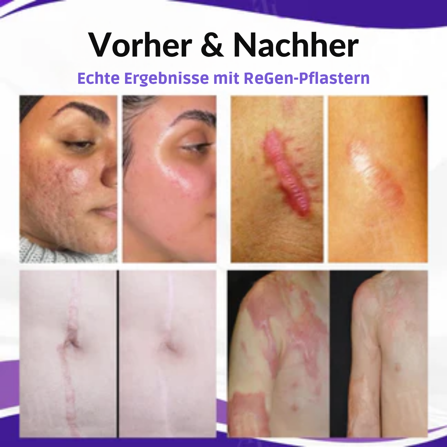 ReGen™ | Zerstöre Hartnäckige Narben Schnell!