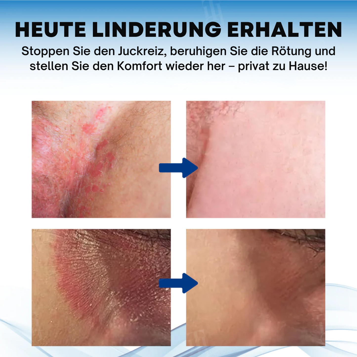 ItchCare™ | 95 % Sofortige Linderung!
