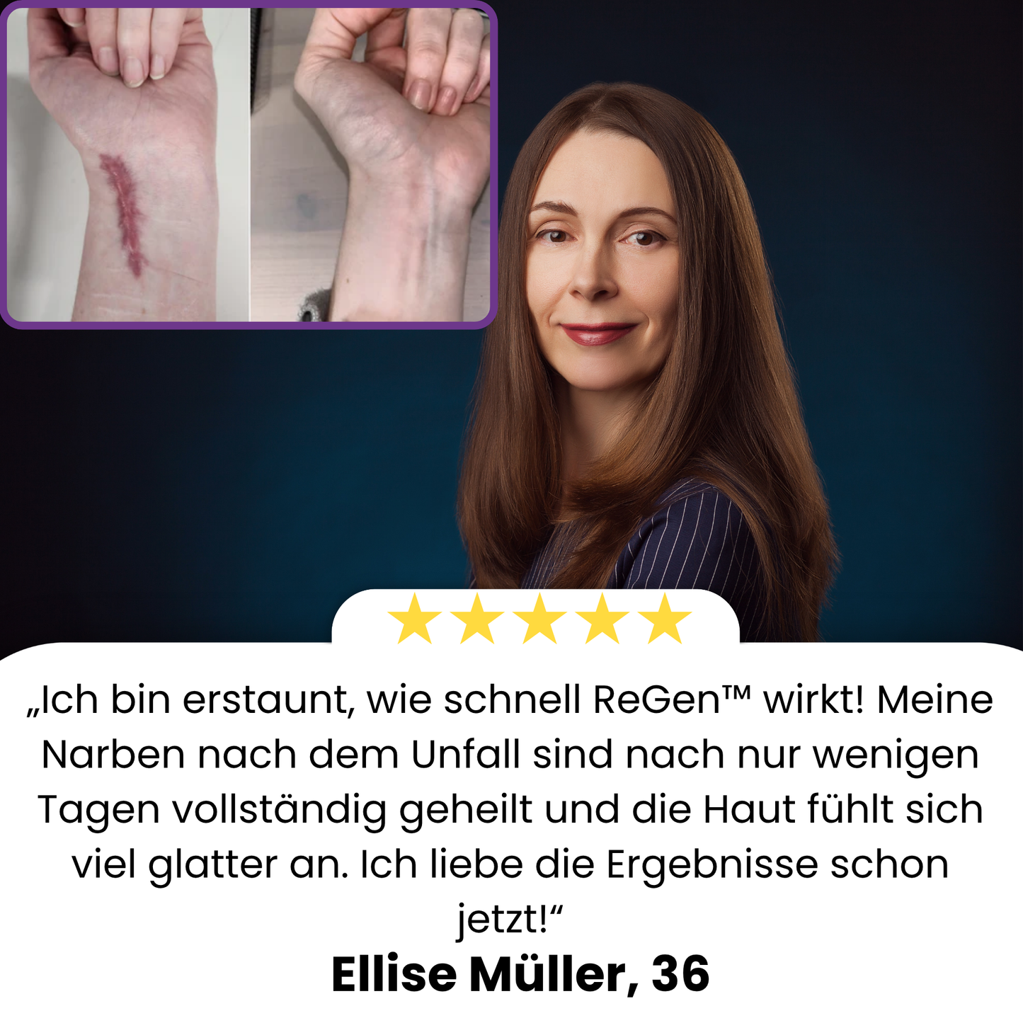 ReGen™ | Zerstöre Hartnäckige Narben Schnell!